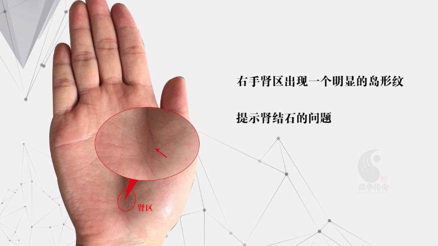 3分钟 教你学会看肾的手纹与反映出来的疾病 掌纹分析顾客(1)__凤凰网
