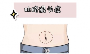 女人肚脐周围长痣痣相解析 女人肚脐上长痣代表什么